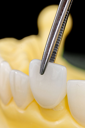 Công nghệ Veneer tương thích sinh học độc đáo